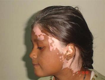 vitiligo 2