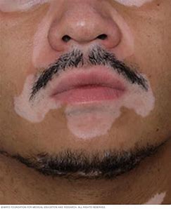 vitiligo 5